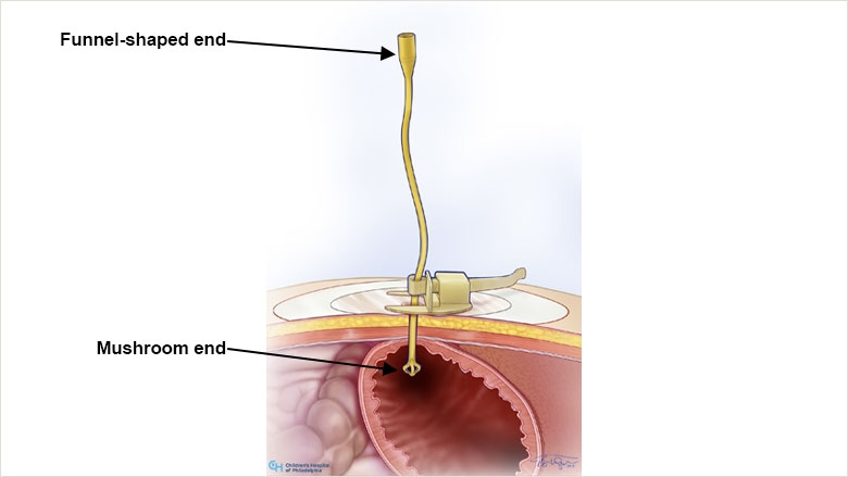 Hollister device: Side view of mushroom G tube in the stomach