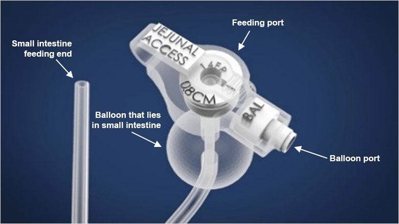 Low-profile balloon J tube