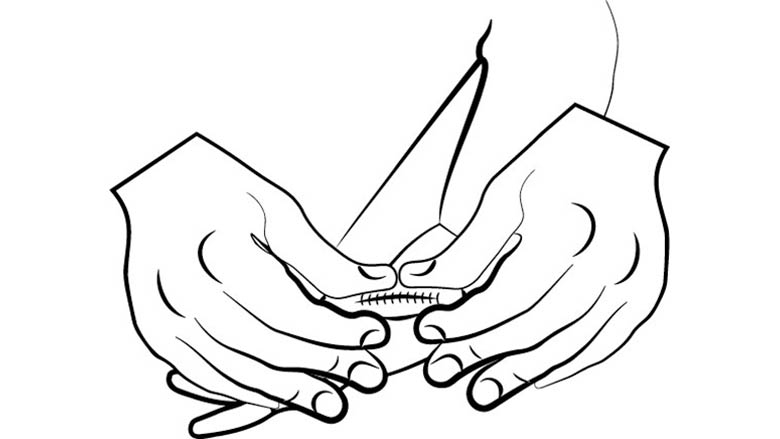 Scar Massage - Rolling