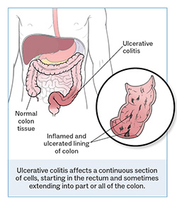 Image of the adult GI tract and a section of the colon that is affected by ulcerative colitis.