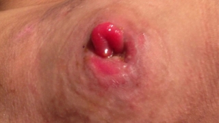 Skin Problems Associated with G Tubes - Prolapse