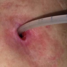 Skin Problems Associated with G Tubes - Stoma