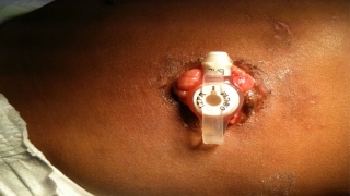 Skin Problems Associated with G Tubes - Granulation