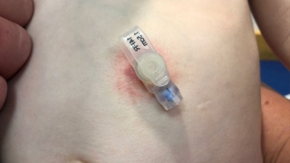 Skin Problems Associated with G Tubes - Redness and Irritation