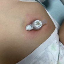 Skin Problems Associated with G Tubes - Skin infection with redness
