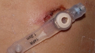 Skin Problems Associated with G Tubes - Mucoid Drainage