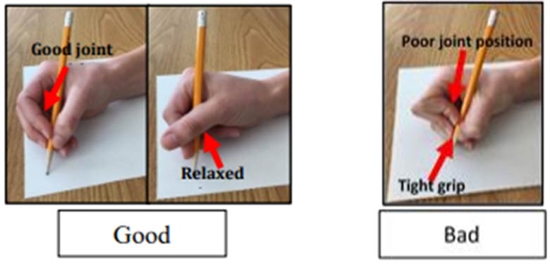 Joint Hypermobility - Writing