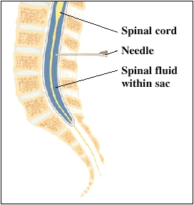 After Lumbar Puncture